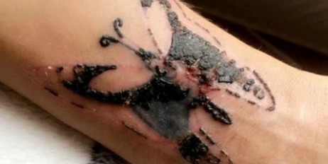 В Британии мастер тату занес девушке смертельную инфекцию - «Мир»