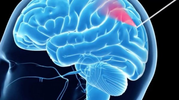 В России разработан стопроцентный метод биопсии опухоли мозга - «Новости Дня»