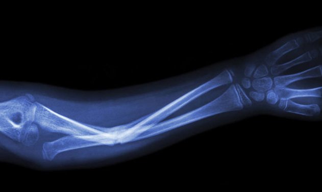 Ученые создали имплантаты, срастающиеся с натуральной костью - «Технологии»